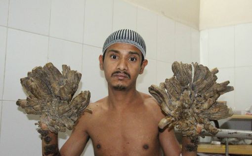 В Бангладеше прооперировали "человека-дерево"
