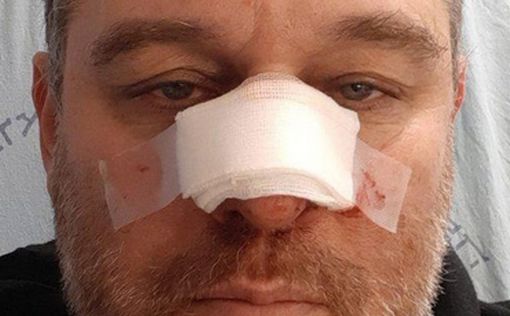Лидеру "гражданских протестов" разбили нос на Бальфур